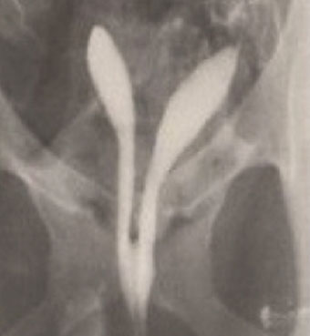 RAHİM İÇİ PERDE (SEPTUM)