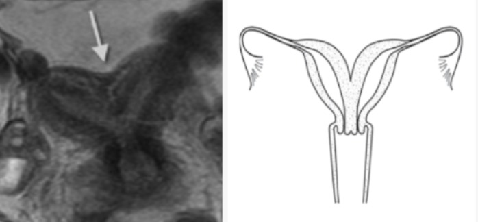 Çift Boynuzlu Rahim