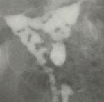 Rahim içi yapışıklık